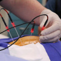 Understanding Radiofrequency Ablation for Chronic Pain Relief