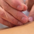 Acupuncture for Chronic Pain Relief: Understanding Causes, Treatments, and Solutions