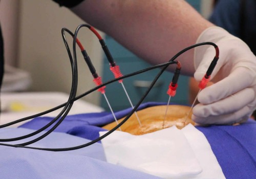 Understanding Radiofrequency Ablation for Chronic Pain Relief