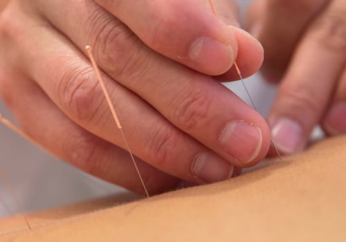 Acupuncture for Chronic Pain Relief: Understanding Causes, Treatments, and Solutions